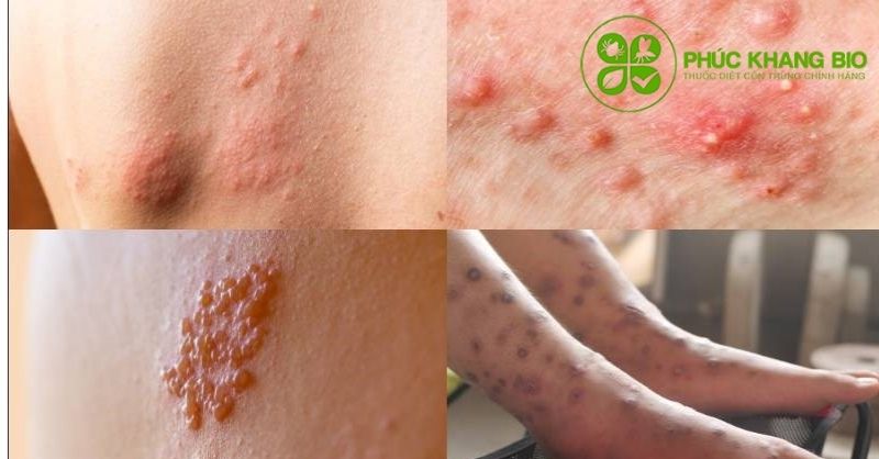 Những căn bệnh do gián truyền nhiễm